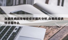 白癜风病因有哪些症状图片分析,白癜风症状特点是什么