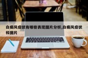白癜风症状有哪些表现图片分析,白癜风症状和图片