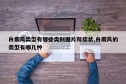 白癜风类型有哪些类别图片和症状,白癜风的类型有哪几种