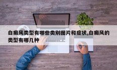 白癜风类型有哪些类别图片和症状,白癜风的类型有哪几种
